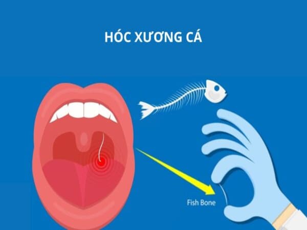 Làm gì khi bị hóc xương cá