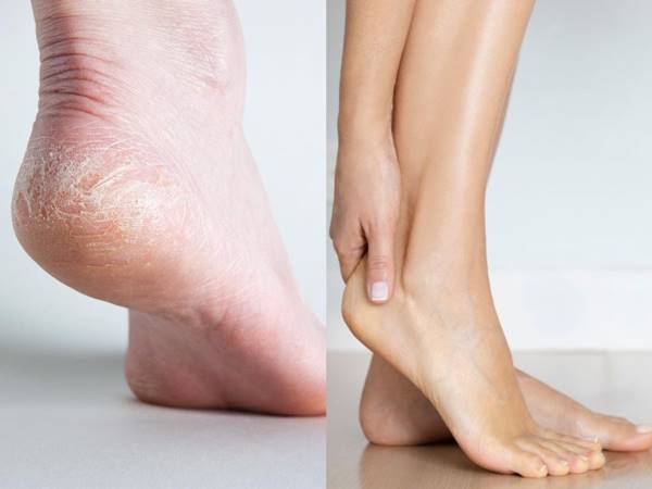 Mẹo trị nứt gót chân tại nhà
